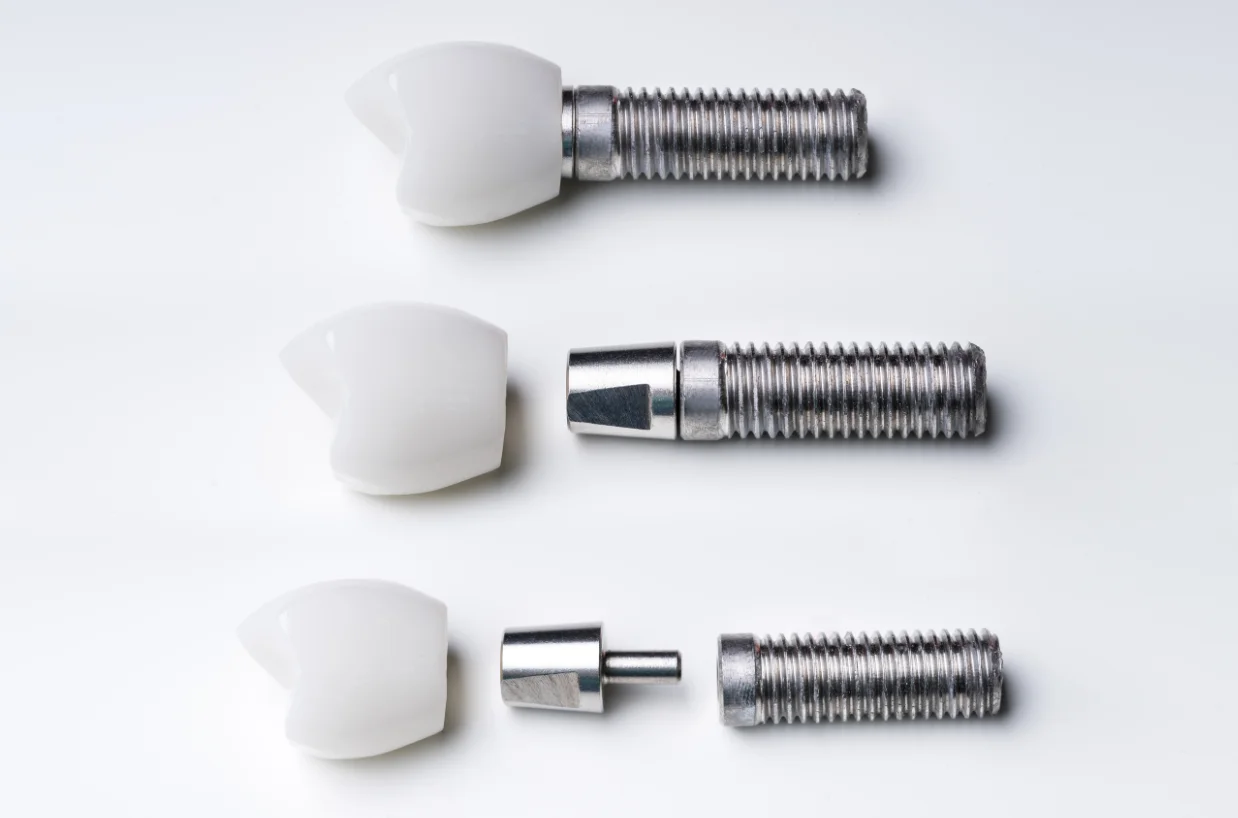 Dental Implants Bromley - Smile 4 U Dental Practice