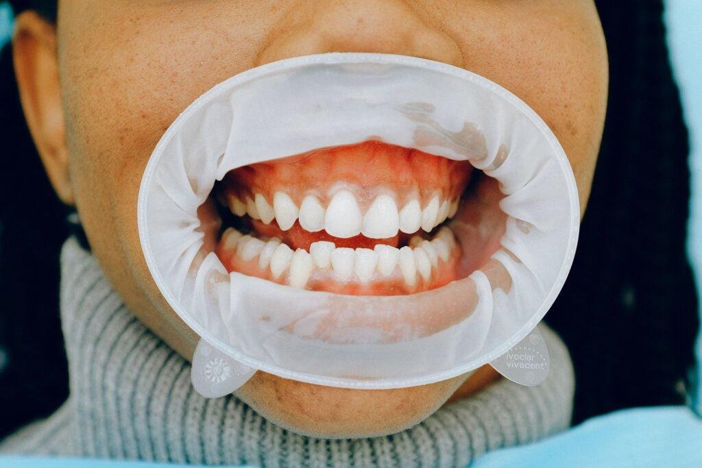 teeth whitening