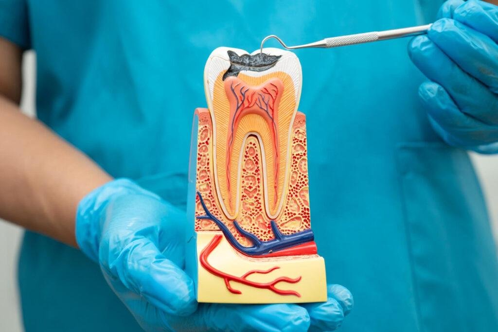root canal therapy