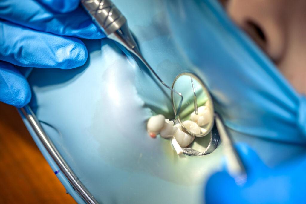 root canal treatment
