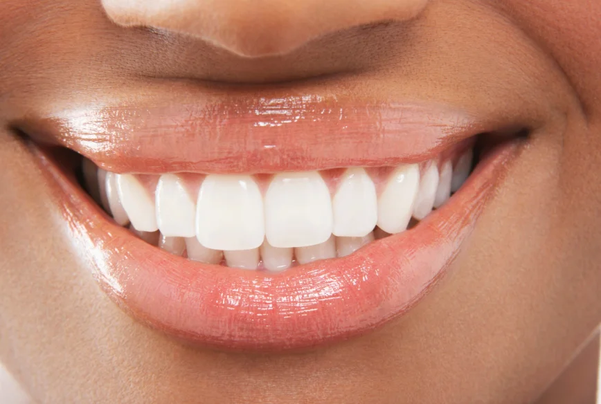 Composite Bonding Croydon - Smile 4 U Dental Practice