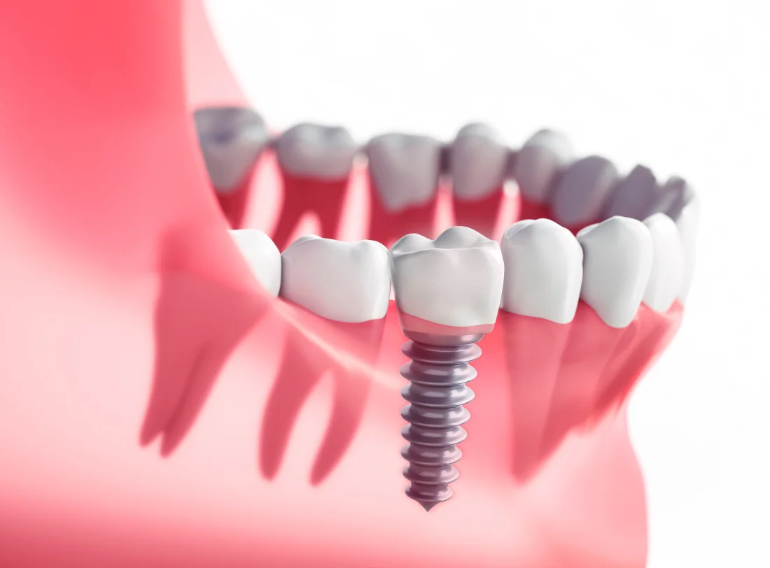 Dental Implants Croydon - Smile 4 U Dental Practice