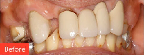 before dental implant 1