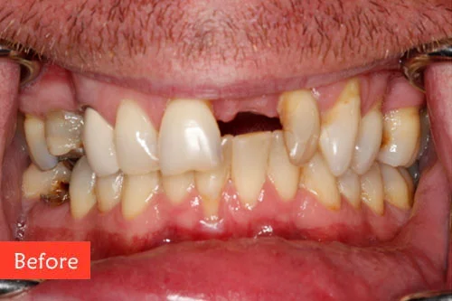 before dental implant 5