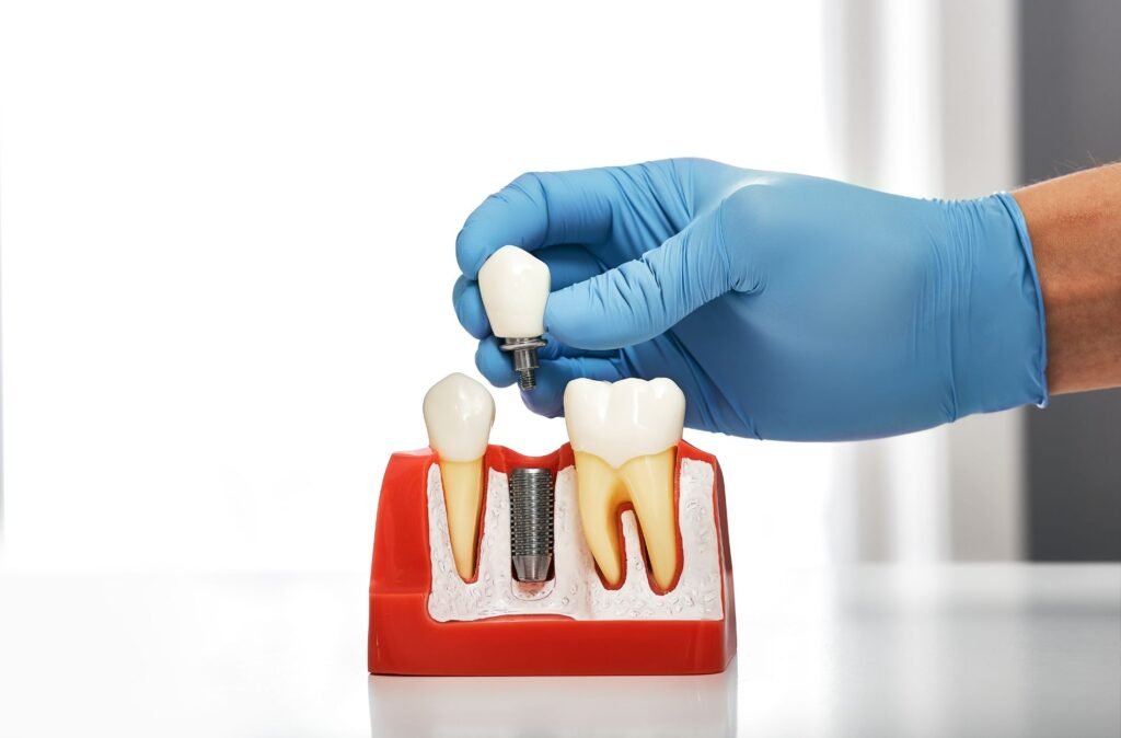 dental implant