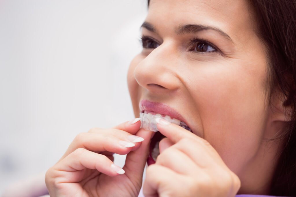 Clear Aligner