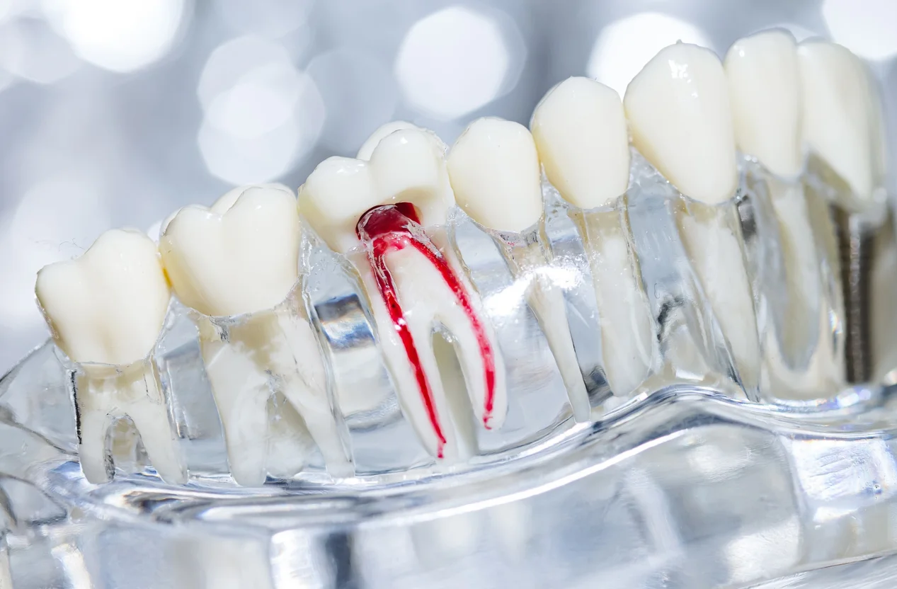 Root Canal Treatment - Kidbrooke Village Dentist (Smile 4 U)