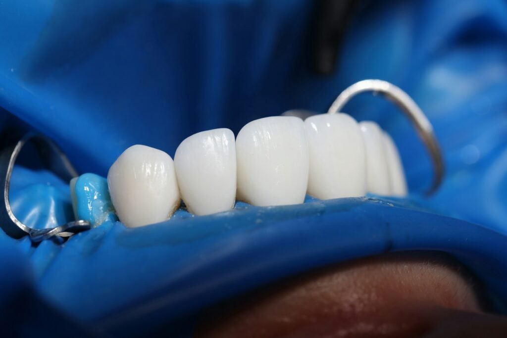 veneers