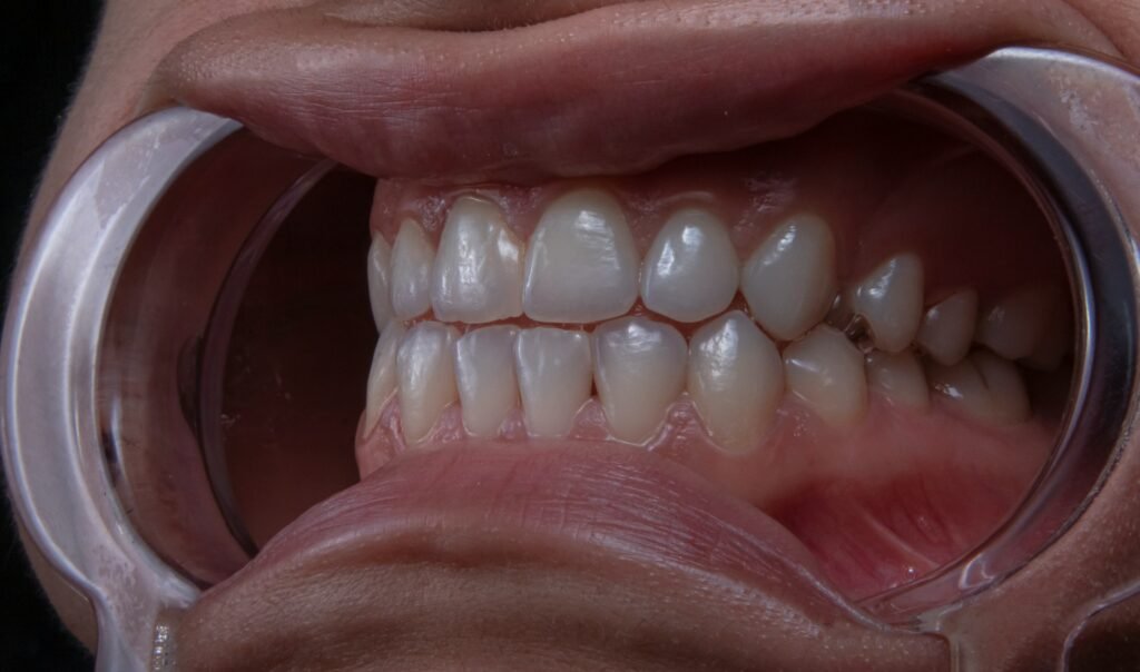 Makes Invisalign