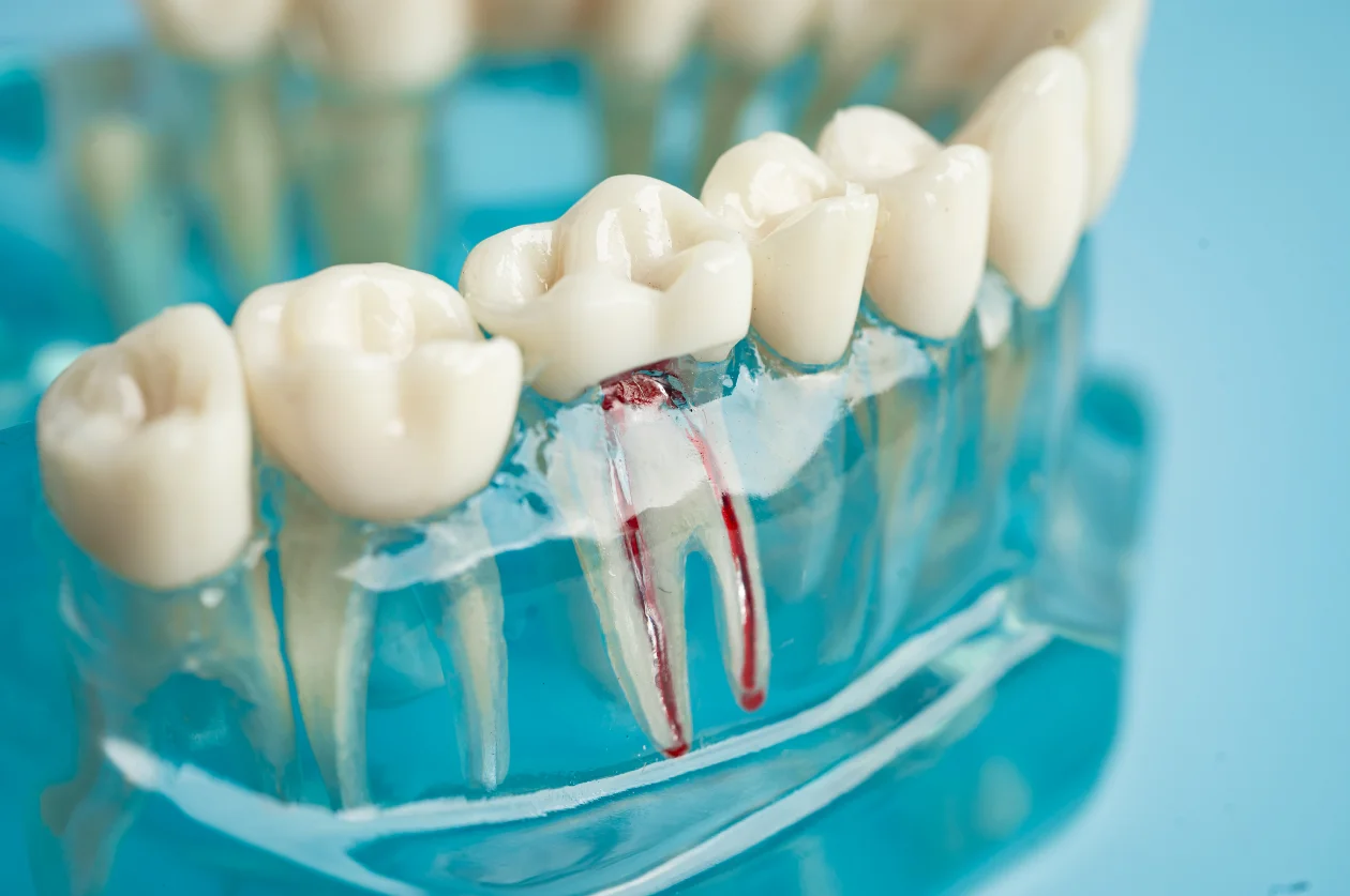 Root Canal Treatment Pimlico & Victoria - McKennell Dental Practice